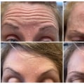 Botox Injections for Wrinkles and Lines