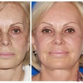 Dermal Fillers for Volume Restoration