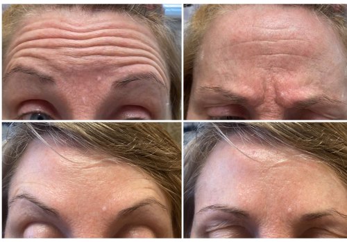 Botox Injections for Wrinkles and Lines
