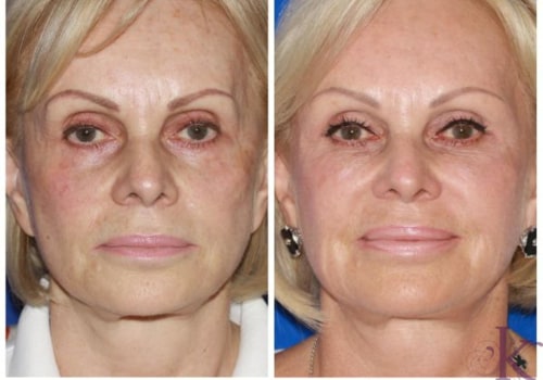 Dermal Fillers for Volume Restoration